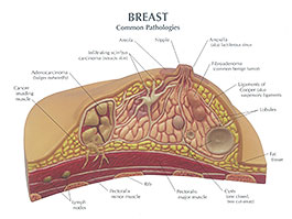 乳腺模型