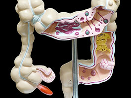 病変大腸模型
